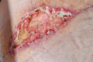 Deiscência de sutura